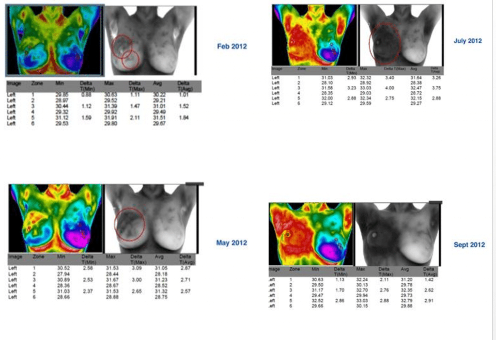 PET, CT Scans, and Thermagraphy for Breast Cancer Imaging
