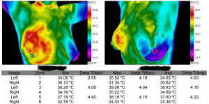 Breast Cancer Thermography