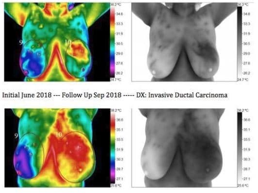 Breast Thermography, medical thermography,Certified Thermographic Technician,Infrared breast health imaging,BTI Turnkey Thermography,Chiropractic Thermography,Medical Thermography Experts,Medical Thermography,thermography services,Thermography,Thermal Imaging Analysis