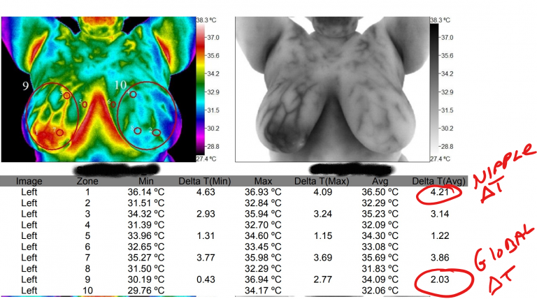 Breast Thermography, medical thermography,Certified Thermographic Technician,Infrared breast health imaging,BTI Turnkey Thermography,Chiropractic Thermography,Medical Thermography Experts,Medical Thermography,thermography services,Thermography,Thermal Imaging Analysis