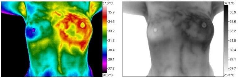 Breast Thermography, medical thermography,Certified Thermographic Technician,Infrared breast health imaging,BTI Turnkey Thermography,Chiropractic Thermography,Medical Thermography Experts,Medical Thermography,thermography services,Thermography,Thermal Imaging Analysis